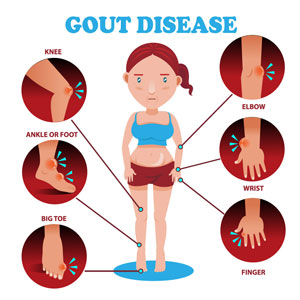 What Is Gout? Symptoms, Causes, Diagnosis, Treatment, And Prevention
